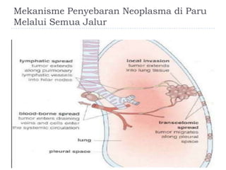 Mekanisme Penyebaran Neoplasma di Paru
Melalui Semua Jalur

 