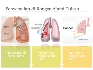 Penyemaian di Rongga Alami Tubuh

Cancer

Neoplasma di
lokasi utama

Menjalar ke
rongga alami
tubuh

Tumbuh di
rongga alami
tubuh

 