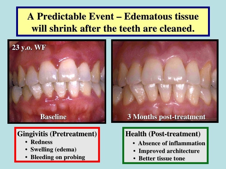 Effect of Periodontal Infections on Fetal Development & Pregnancy Out…