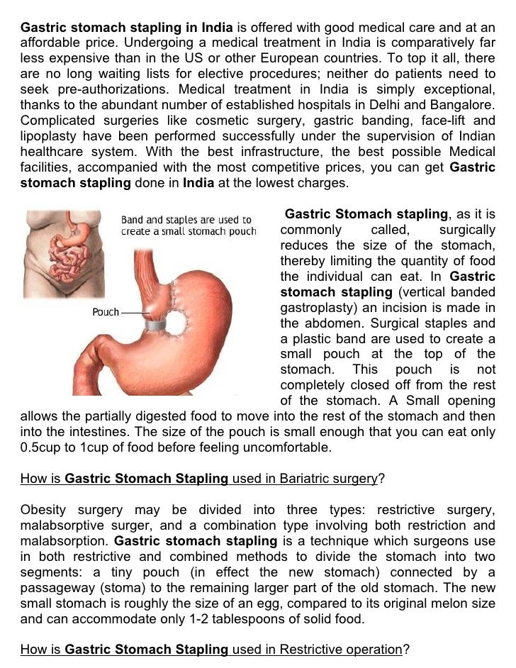 Effective price Gastric stomach stapling in India with refreshing