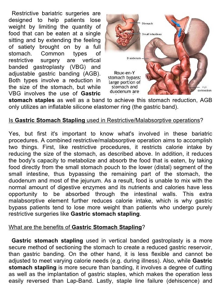 Effective price Gastric stomach stapling in India with refreshing