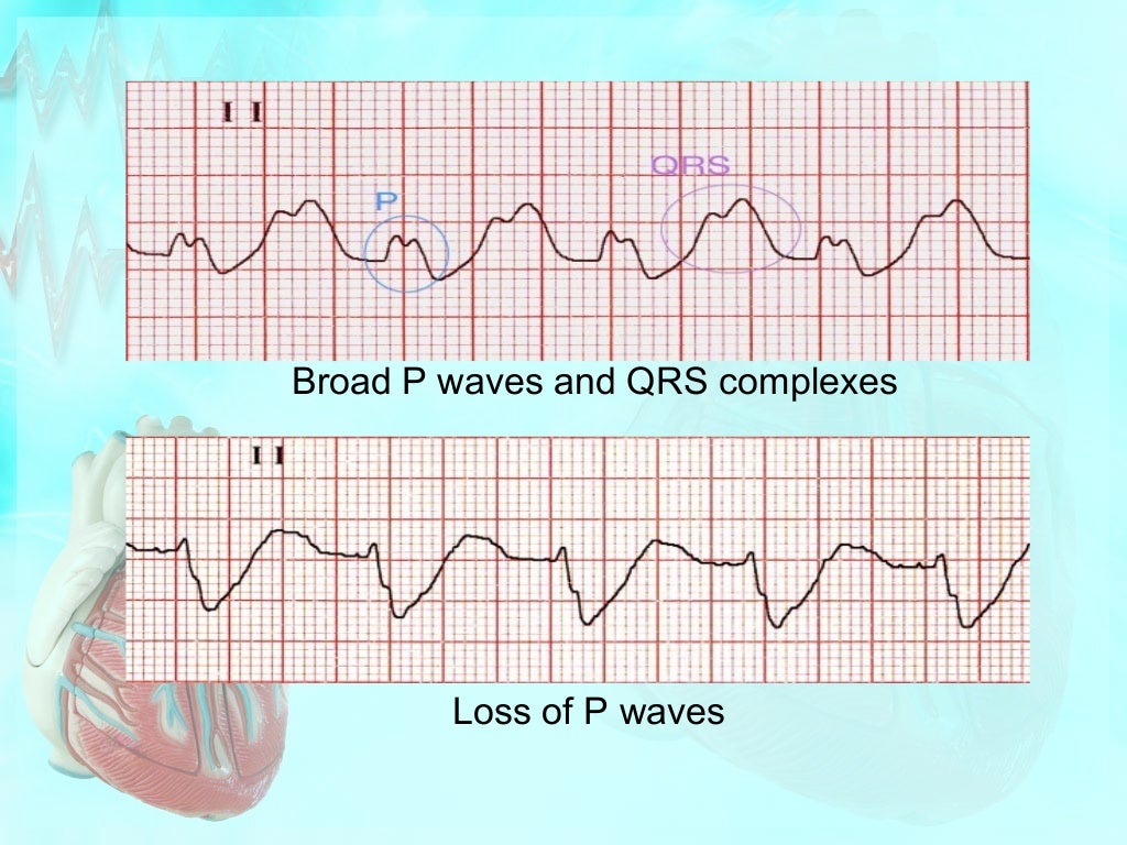 Effect of electrolytes on cardiac rhythm