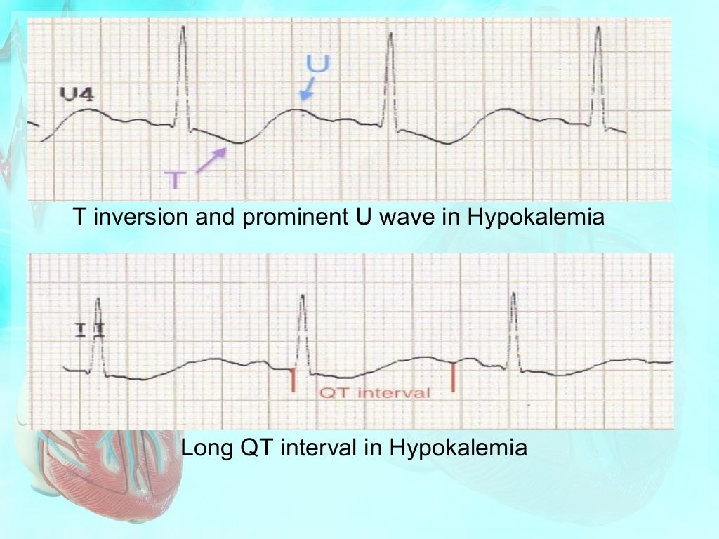 Effect of electrolytes on cardiac rhythm