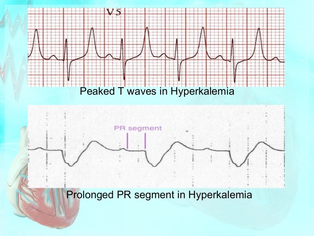 Effect of electrolytes on cardiac rhythm