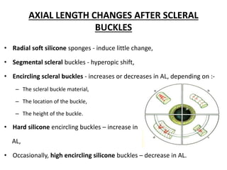 Buckle Effect Effect of scleral buckle on geometry of eye.pptx