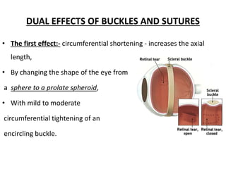 Buckle Effect Effect of scleral buckle on geometry of eye.pptx
