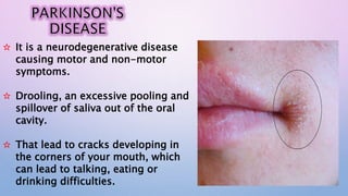 Drooling Ed Effect of systemic diseases on salivary glands | PPTX