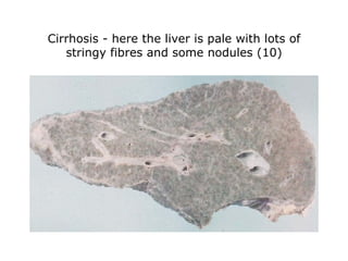 Cirrhosis - here the liver is pale with lots of stringy fibres and some nodules (10) 