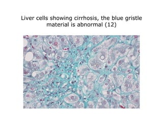 Liver cells showing cirrhosis, the blue gristle material is abnormal (12) 