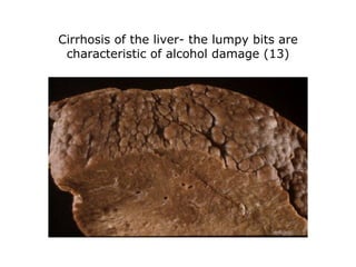 Cirrhosis of the liver- the lumpy bits are characteristic of alcohol damage (13) 