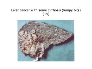 Liver cancer with some cirrhosis (lumpy bits)  (14)  
