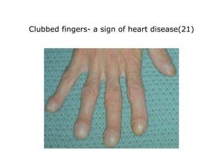 Clubbed fingers- a sign of heart disease(21) 