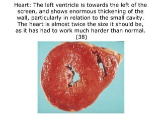 Heart:  The left ventricle is towards the left of the screen, and shows enormous thickening of the wall, particularly in r...