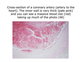 Cross-section of a coronary artery (artery to the heart). The inner wall is very thick (pale pink) and you can see a massi...