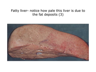 Fatty liver- notice how pale this liver is due to the fat deposits (3) 