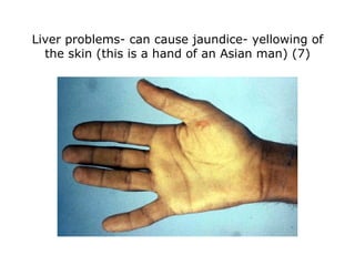 Liver problems- can cause jaundice- yellowing of the skin (this is a hand of an Asian man) (7) 
