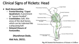Head In Rickets VITAMIN D DEFICIENCY IN CHILDREN.pptx