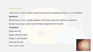 Heatstroke Rash EFFECTS OF HEAT STRESS-HEAT STROKE, HEAT EXHAUSTION | PPTX
