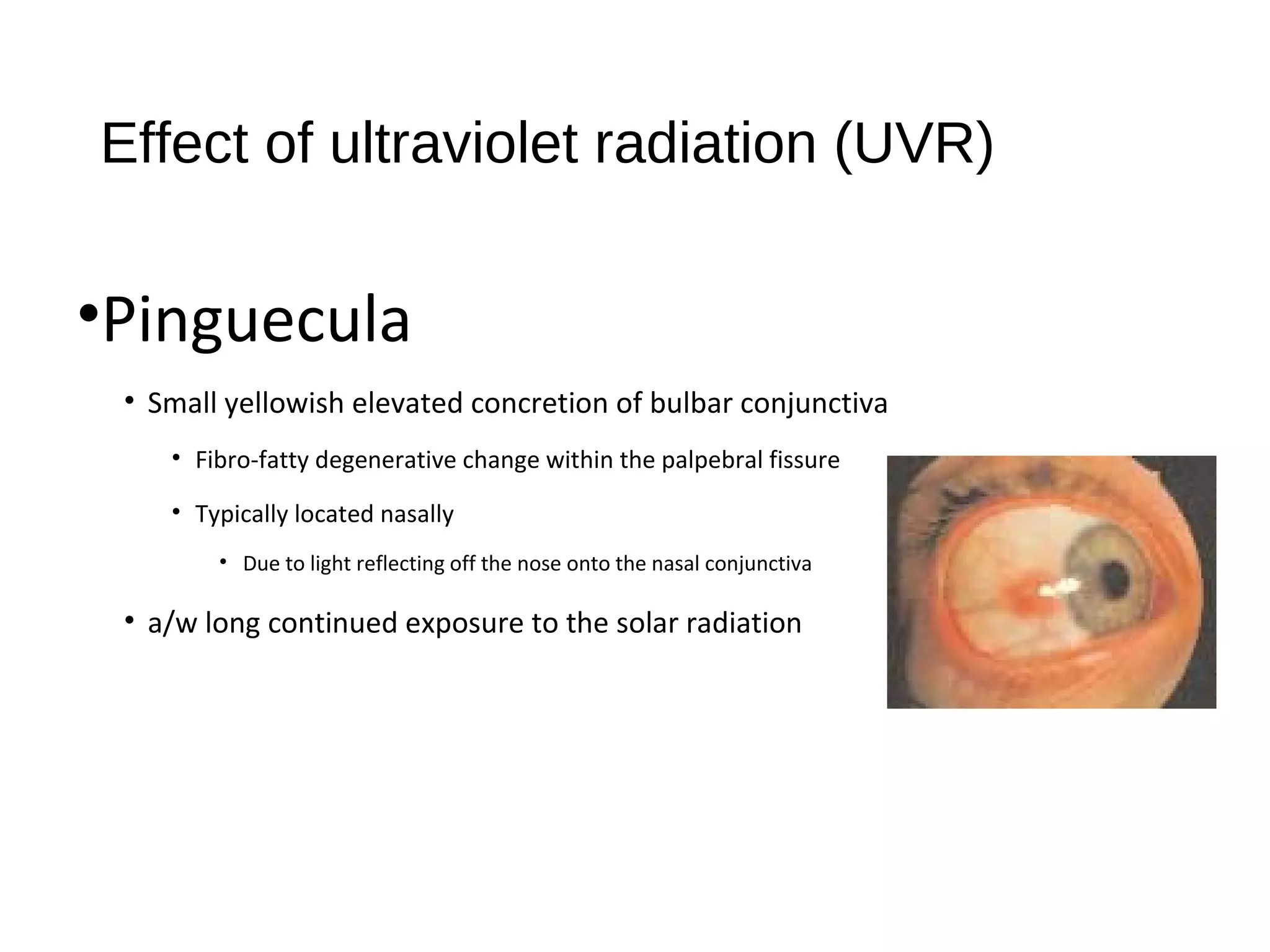 Effect of ultraviolet radiation (UVR)
•Pinguecula
• Small yellowish elevated concretion of bulbar conjunctiva
• Fibro-fatty degenerative change within the palpebral fissure
• Typically located nasally
• Due to light reflecting off the nose onto the nasal conjunctiva
• a/w long continued exposure to the solar radiation
 
