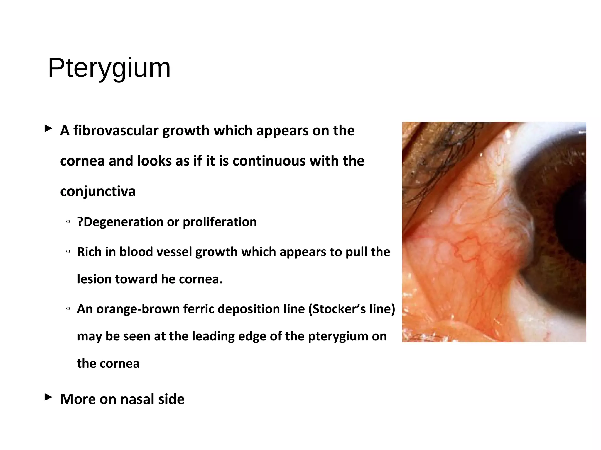 Pterygium
 A fibrovascular growth which appears on the
cornea and looks as if it is continuous with the
conjunctiva
◦ ?Degeneration or proliferation
◦ Rich in blood vessel growth which appears to pull the
lesion toward he cornea.
◦ An orange-brown ferric deposition line (Stocker’s line)
may be seen at the leading edge of the pterygium on
the cornea
 More on nasal side
 