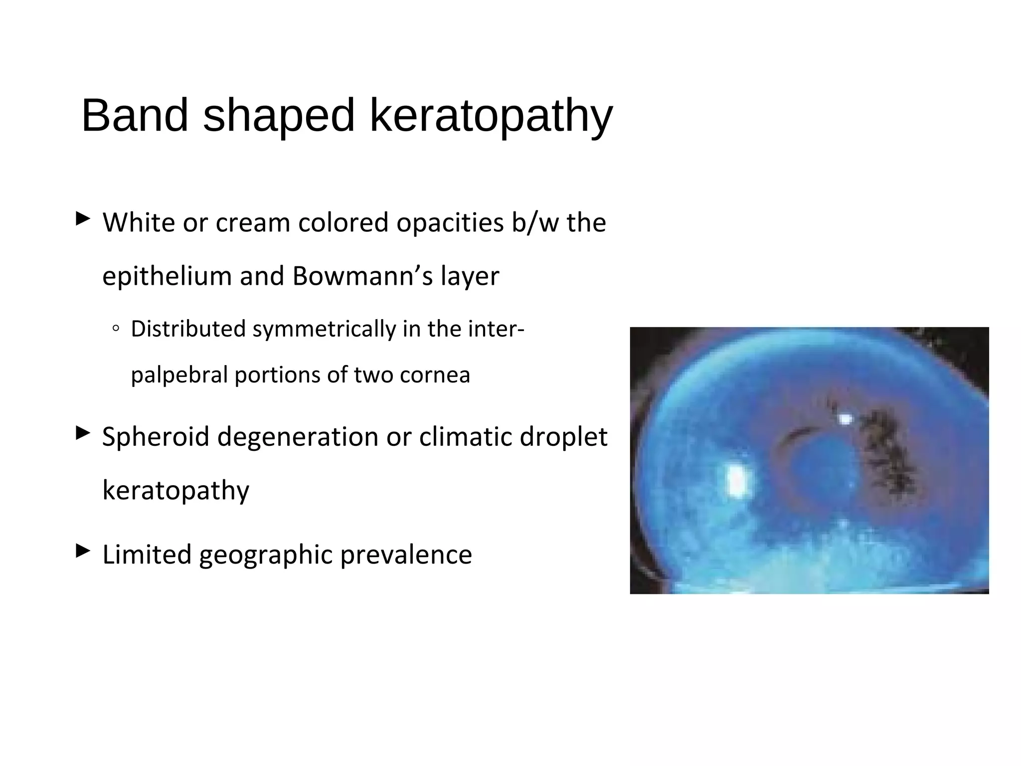 Band shaped keratopathy
 White or cream colored opacities b/w the
epithelium and Bowmann’s layer
◦ Distributed symmetrically in the inter-
palpebral portions of two cornea
 Spheroid degeneration or climatic droplet
keratopathy
 Limited geographic prevalence
 