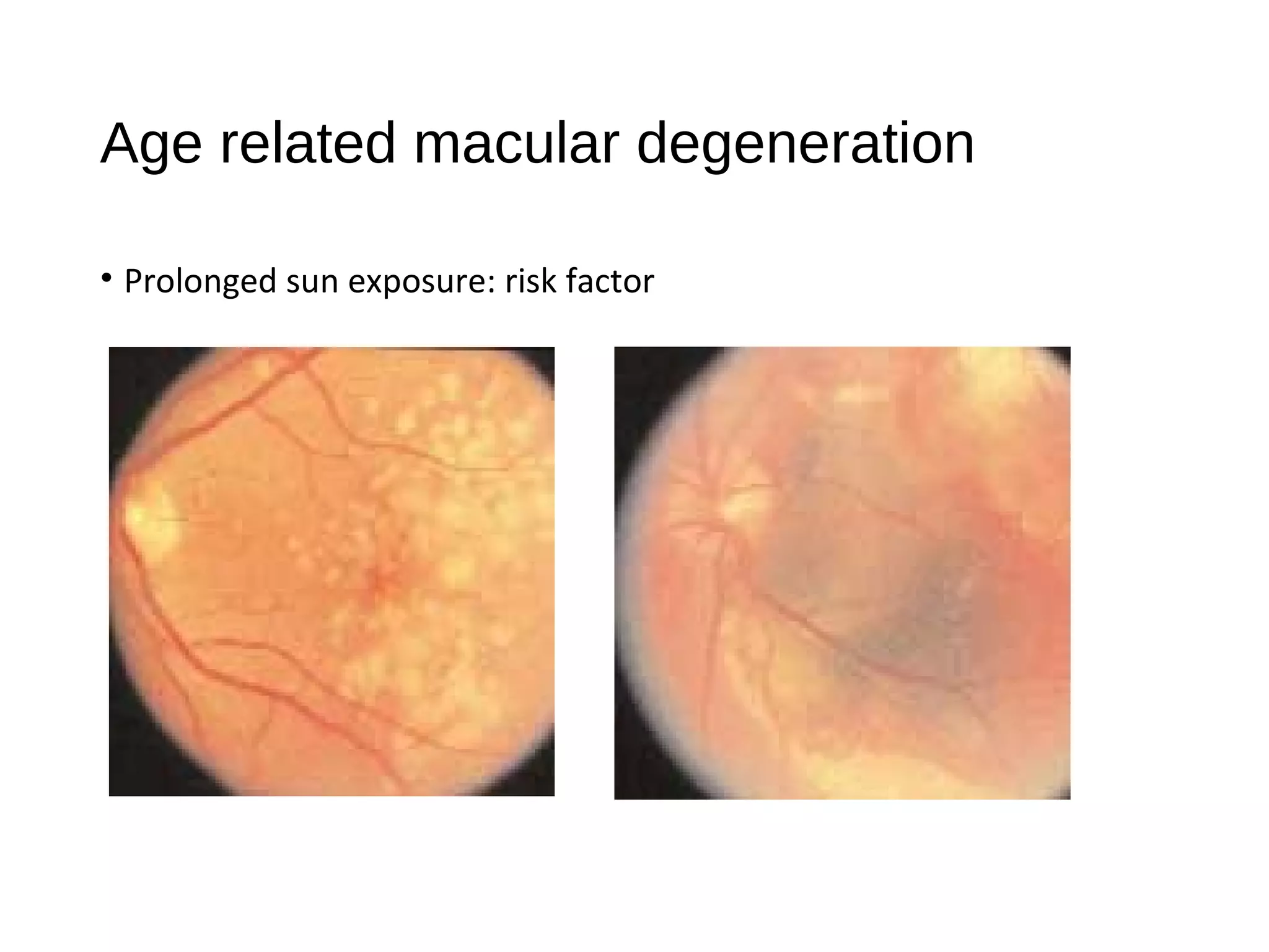 Age related macular degeneration
• Prolonged sun exposure: risk factor
 