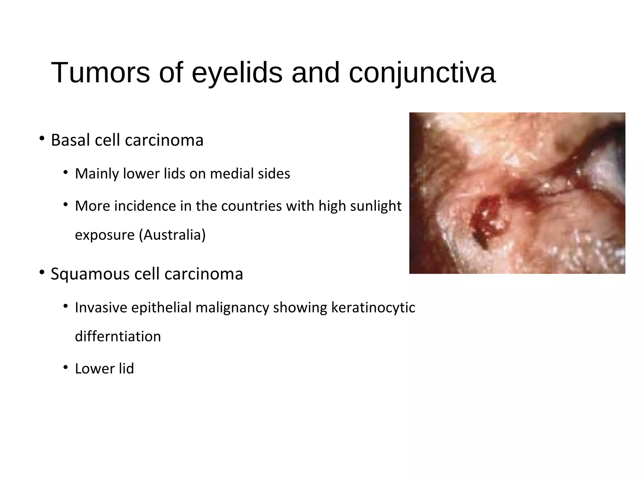 Tumors of eyelids and conjunctiva
• Basal cell carcinoma
• Mainly lower lids on medial sides
• More incidence in the countries with high sunlight
exposure (Australia)
• Squamous cell carcinoma
• Invasive epithelial malignancy showing keratinocytic
differntiation
• Lower lid
 