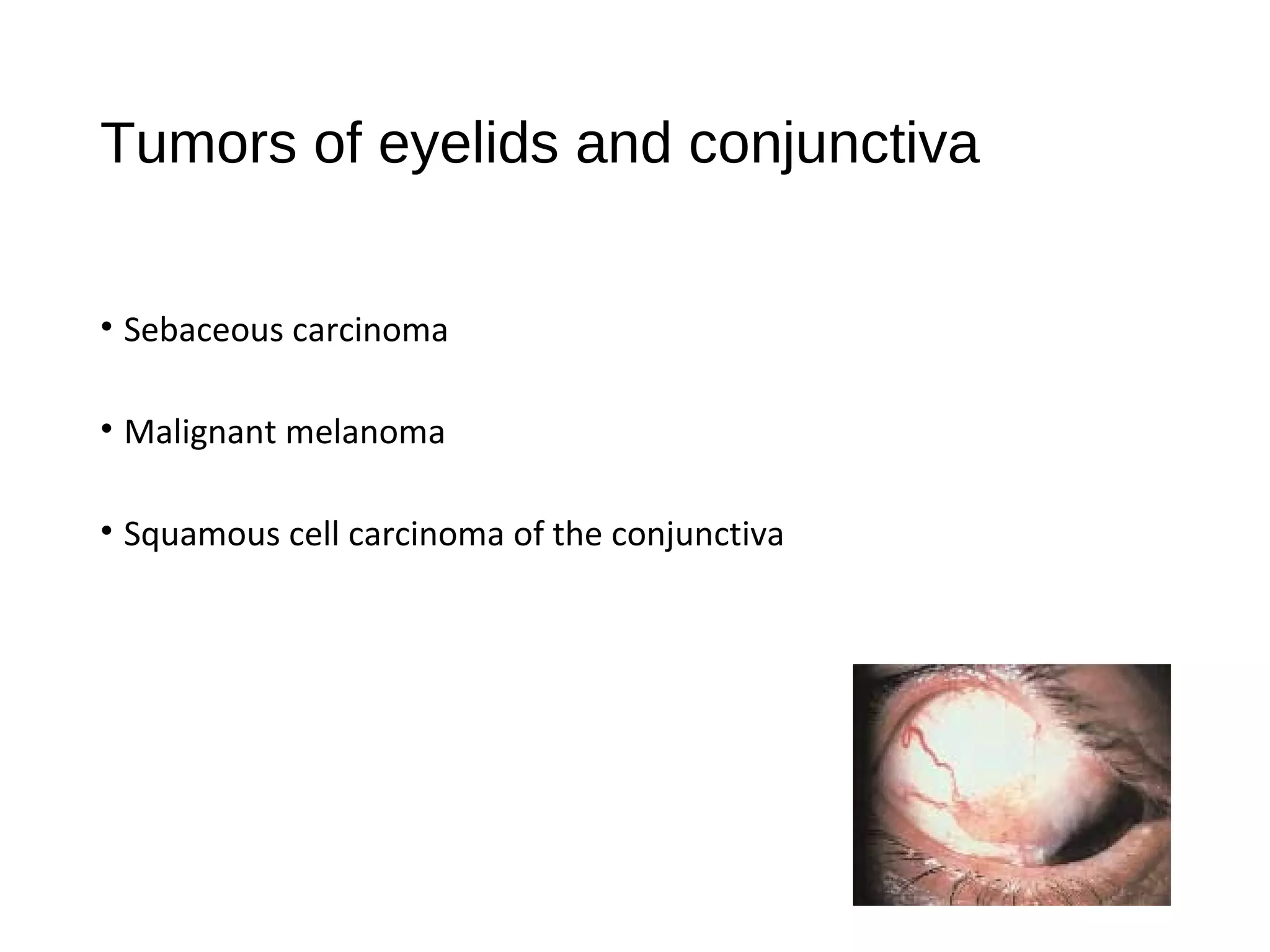 Tumors of eyelids and conjunctiva
• Sebaceous carcinoma
• Malignant melanoma
• Squamous cell carcinoma of the conjunctiva
 