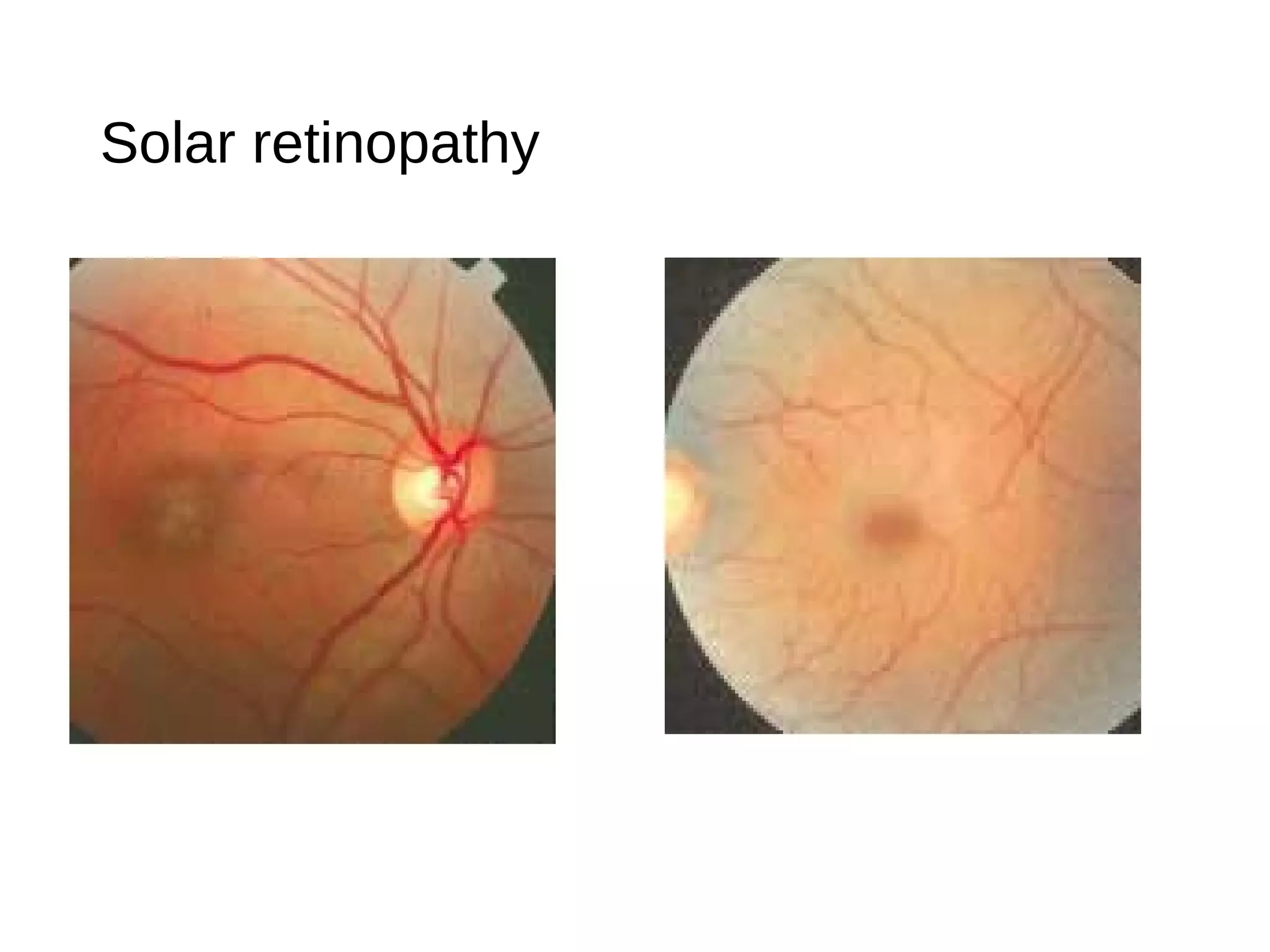 Solar retinopathy
 