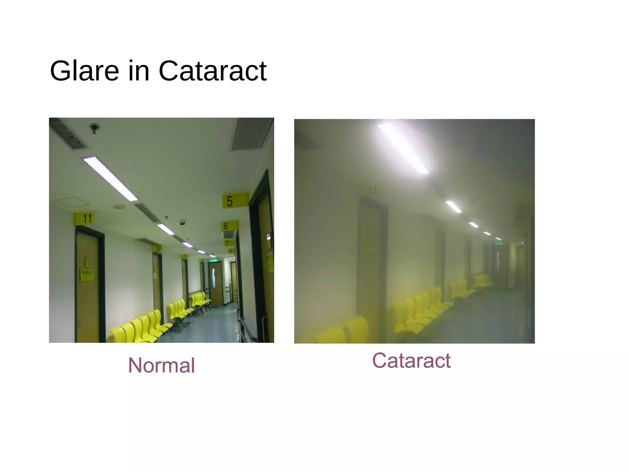 Glare in Cataract
Normal Cataract
 