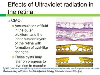 Eye Rays Effect Effects of radiation and glare on human eyes | PPTX