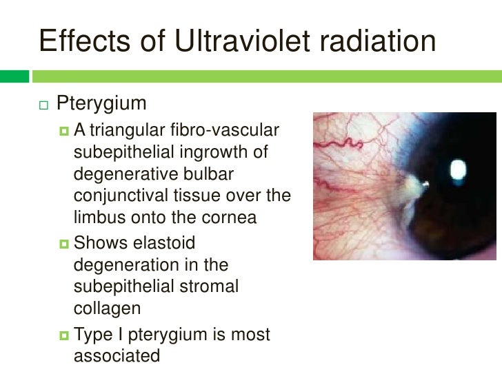 Effects of radiation and glare on human eyes