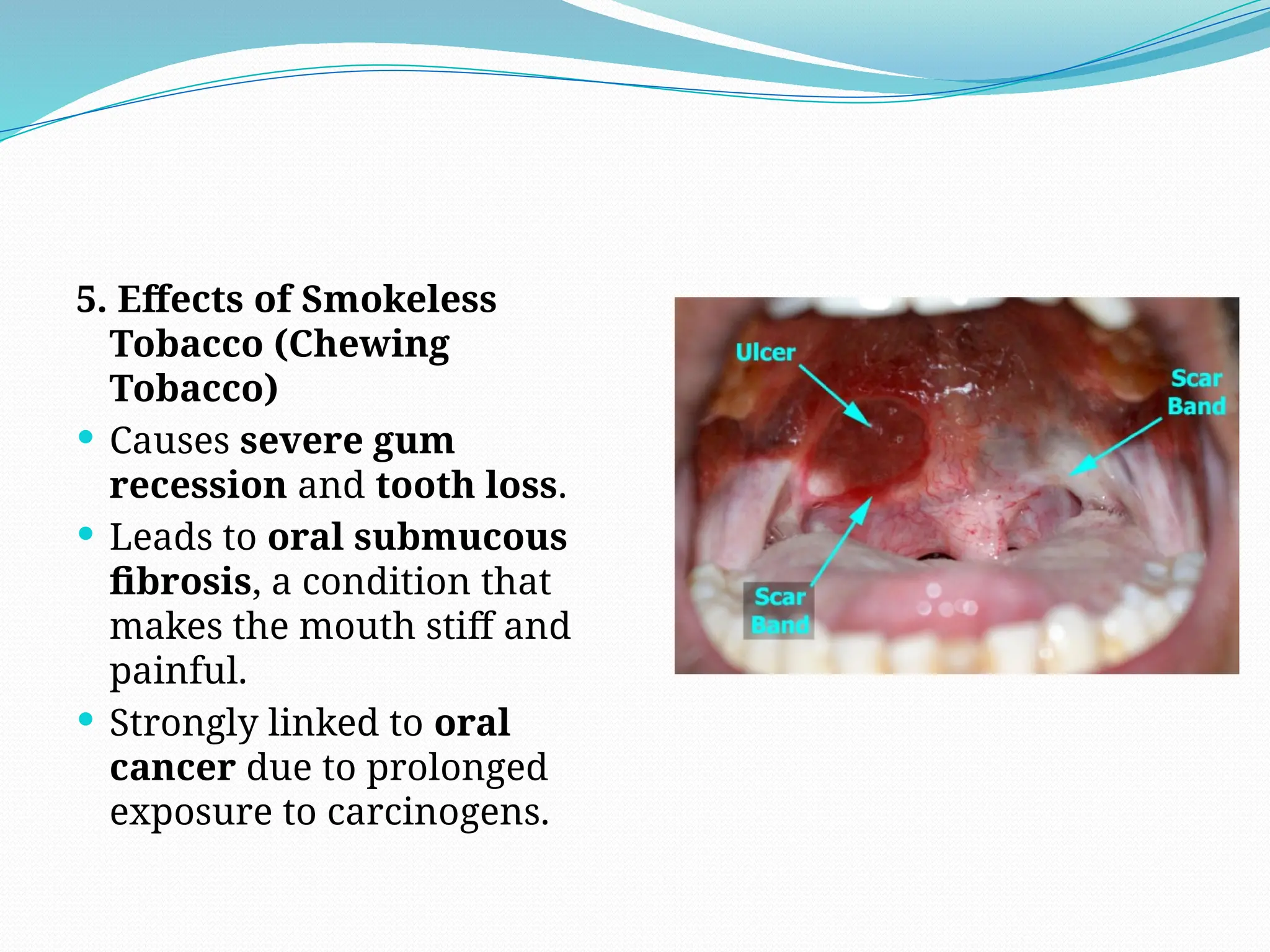 gum recession from chewing tobacco Snus causes mucosal lesions & gingival SmileScape - Tobacco chewing and