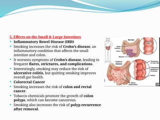 tobacco and ulcerative colitis Byproduct Points to Safer Relief Path for Transdermal Nicotine for Active Ulcerative