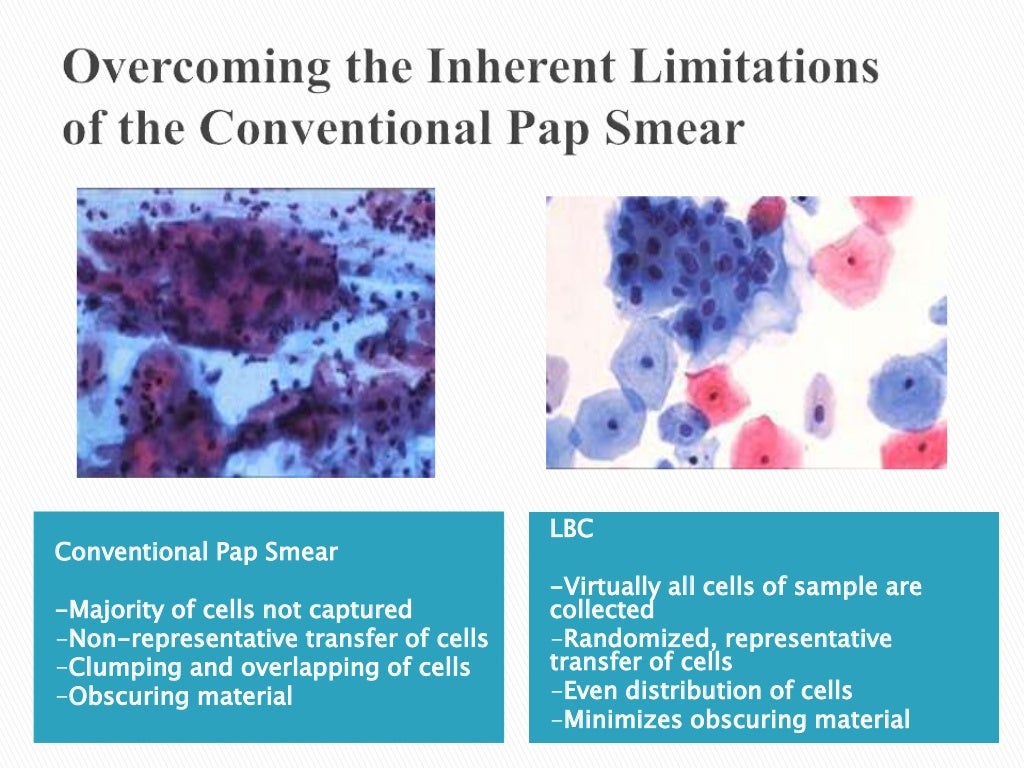 Efficacy of liquid based cytology versus conventional smears