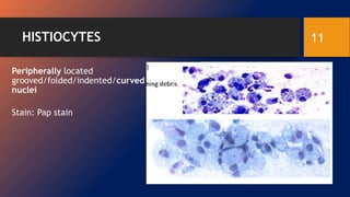 HISTIOCYTES
Peripherally located
grooved/folded/indented/curved
nuclei
Stain: Pap stain
11
 