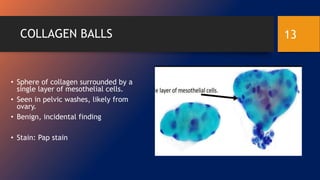 COLLAGEN BALLS
• Sphere of collagen surrounded by a
single layer of mesothelial cells.
• Seen in pelvic washes, likely from
ovary.
• Benign, incidental finding
• Stain: Pap stain
13
 