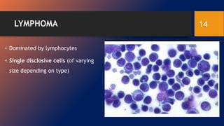 LYMPHOMA
• Dominated by lymphocytes
• Single disclosive cells (of varying
size depending on type)
14
 