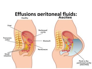 Effusions peritoneal fluids:
 