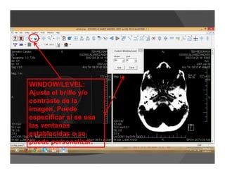 WINDOW/LEVEL:
Ajusta el brillo y/o
contraste de la
imagen. Puede
especificar si se usa
las ventanas
establecidas o se
puede personalizar.
 