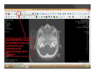 ALPHA/BETA: Ajusta
la configuración de
coherencia y/o
tendencia de
blanco/negro de la
imagen.
 