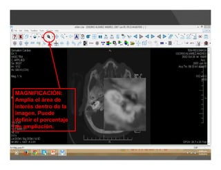 MAGNIFICACIÓN:
Amplía el área de
interés dentro de la
imagen. Puede
definir el porcentaje
de ampliación.
 