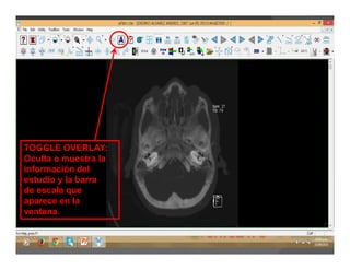 TOGGLE OVERLAY:
Oculta o muestra la
información del
estudio y la barra
de escala que
aparece en la
ventana.
 