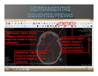 PREVIOUS Y NEXT STUDY:
Carga el estudio anterior y
siguiente desde la lista de
exámenes.
PREVIOUS Y NEXT
IMAGE: Carga la
imagen anterior y
siguiente desde la
lista de exámenes.
PREVIOUS Y NEXT SERIE:
Carga la serie anterior y
siguiente desde la lista de
exámenes.
 