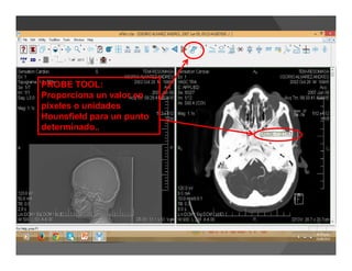 PROBE TOOL:
Proporciona un valor en
píxeles o unidades
Hounsfield para un punto
determinado..
 