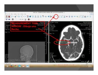 MEASUREMENT TOOL
ARROW : Dibuja una
flecha.
 
