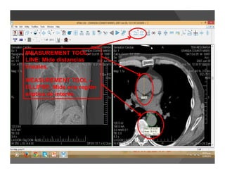 MEASUREMENT TOOL -
LINE: Mide distancias
lineales.
MEASUREMENT TOOL –
ELLIPSE: Mide una región
elíptica de interés.
 