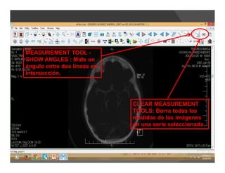 MEASUREMENT TOOL -
SHOW ANGLES : Mide un
ángulo entre dos líneas en
intersección.
CLEAR MEASUREMENT
TOOLS: Borra todas las
medidas de las imágenes
en una serie seleccionada.
 