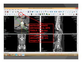 AUTO-GENERATE
ORTHOGONAL MPR
TOOLS : Crea dos
series de MPR
ortogonales y una
oblicua desde una
imagen 2D.
 