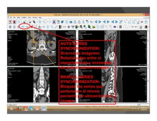 AUTO SERIES
SYNCHRONIZATION:
Sincroniza imágenes
Relacionadas entre sí
espacialmente y scaneadas
durante el mismo examen.
MANUAL SERIES
SYNCHRONIZATION:
Bloquea las series que
pertenecen al mismo
paciente por ubicación de la
imagen.
 